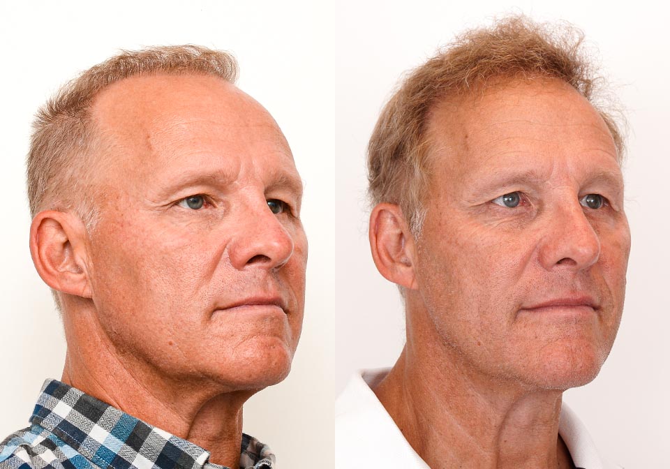 FUE Hair Transplant Before & After Gallery Hair Transplant Toronto Clinic